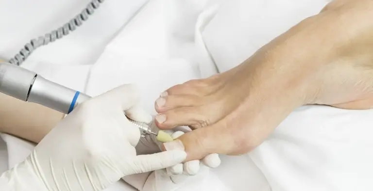 frezowanie paznokcia u stopy
